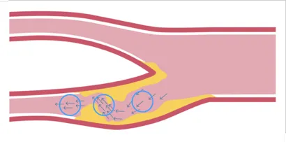 12.2_direction_of_flow_in_stenosis
