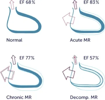 Acute MR Ejection Fraction