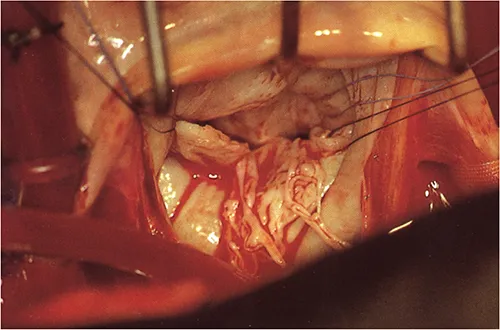 Ruptured Chordae