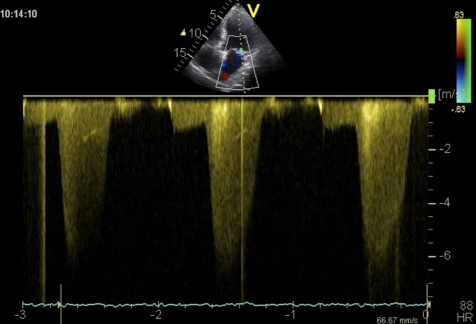Pre-systolic mitral regurgitation