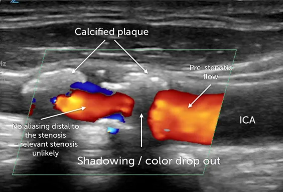 12.8_calcified_lesion_illustr