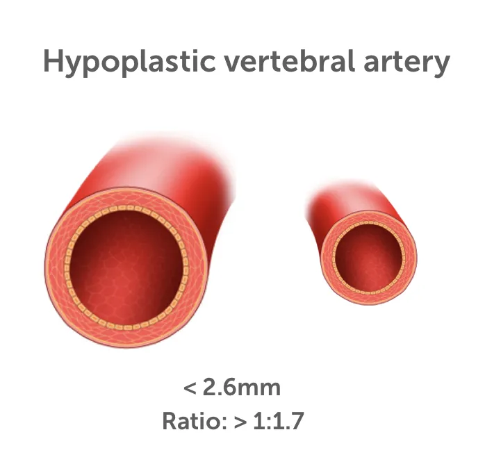 13.3_hypoplastic_va