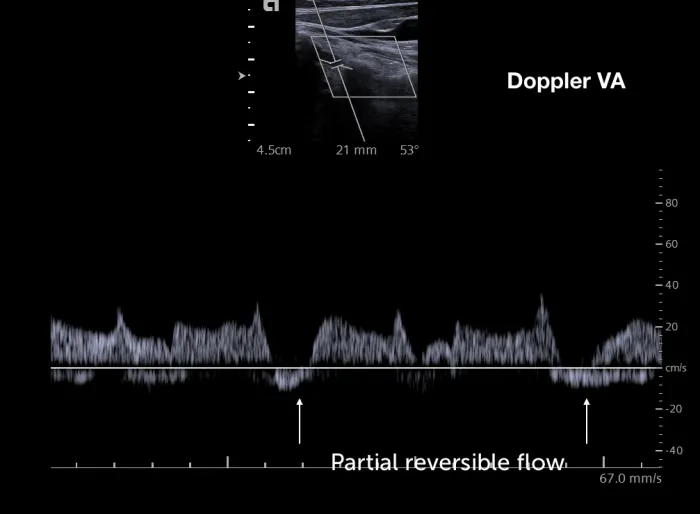 14.6_doppler_stage_subclav_steal_ii