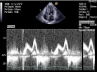 Pulsed Wave Doppler Tracing of mitral inflow