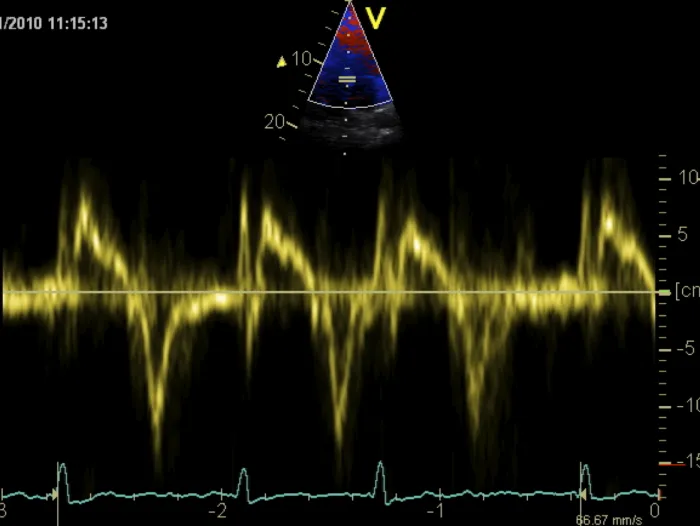TDI spectrum_Normal