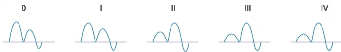 PVSignal_Diastolic_Dysfunction