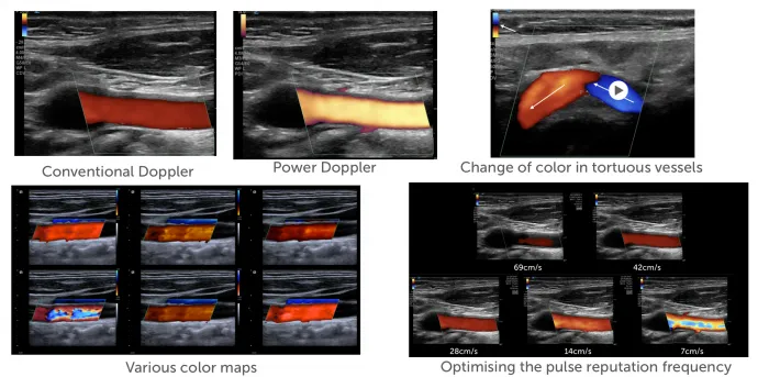 5.7_color_doppler_tips