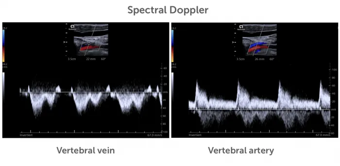 7.x_spectral_doppler_vavv