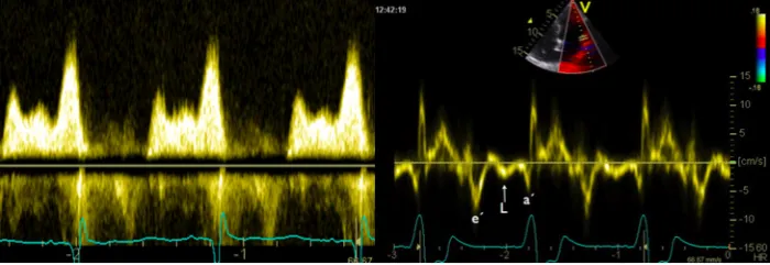 L-wave seen between the E- and the A-wave