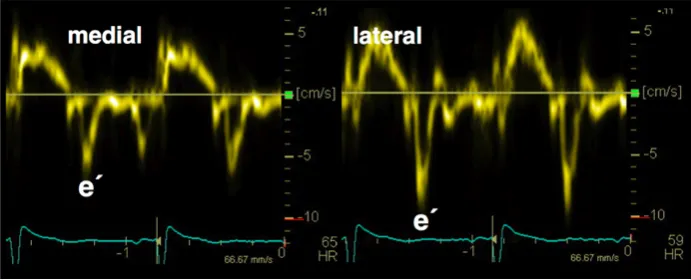 Tissue Doppler tracing