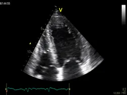 ventricular hypertrophy
