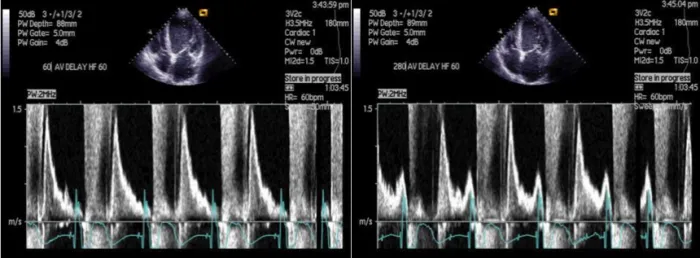 patient with a DDD pacemaker
