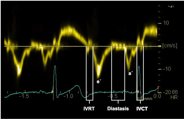 Timing of events based on the tissue Dopple