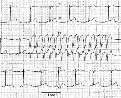 Non-sustained VT possibly as a result of an electrical imbalance, autonomic alterations or volume shift.