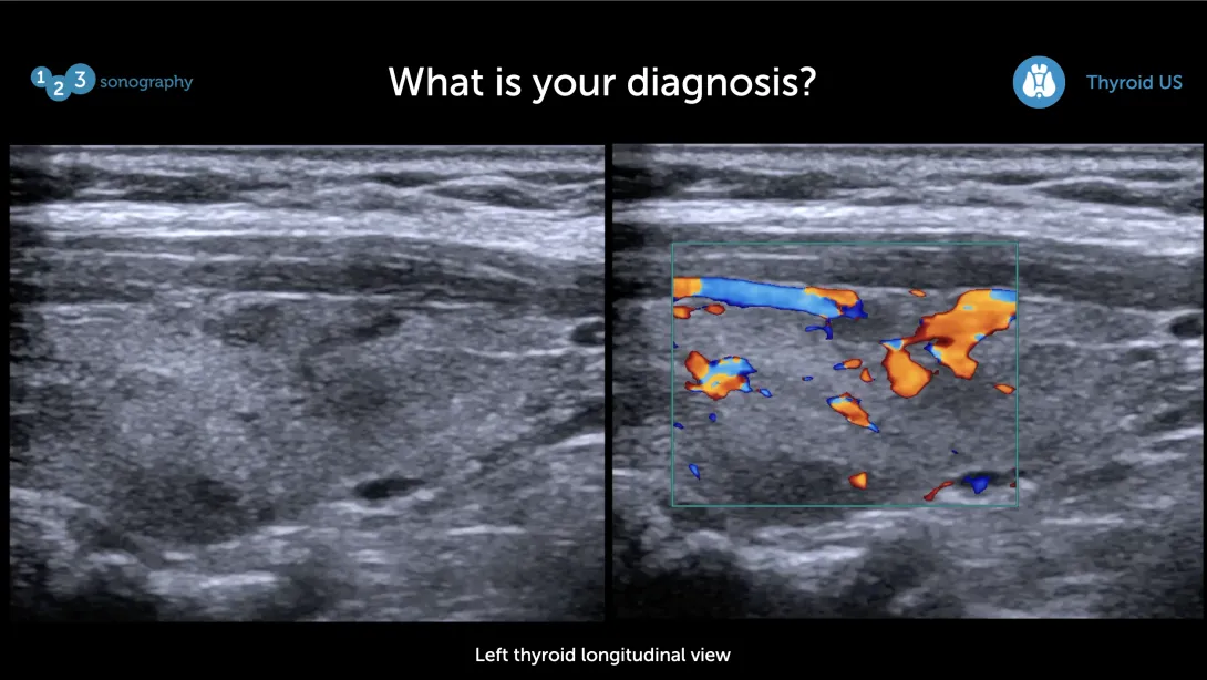 Thyroid Ultrasound – Spot the problem Part 1