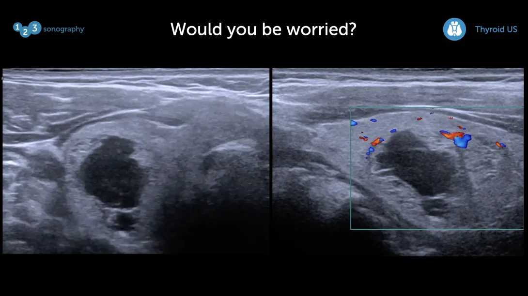 Thyroid Ultrasound – Spot the problem Part 3