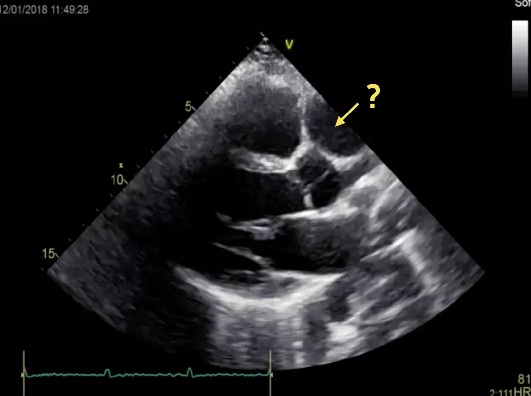 Echo Challenge - What is the structure adjacent to the ascending aorta?