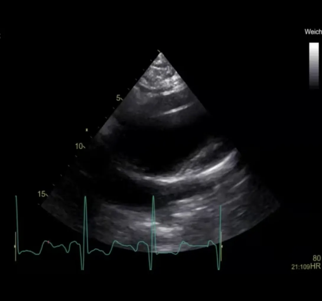 True Aortic Dissection?