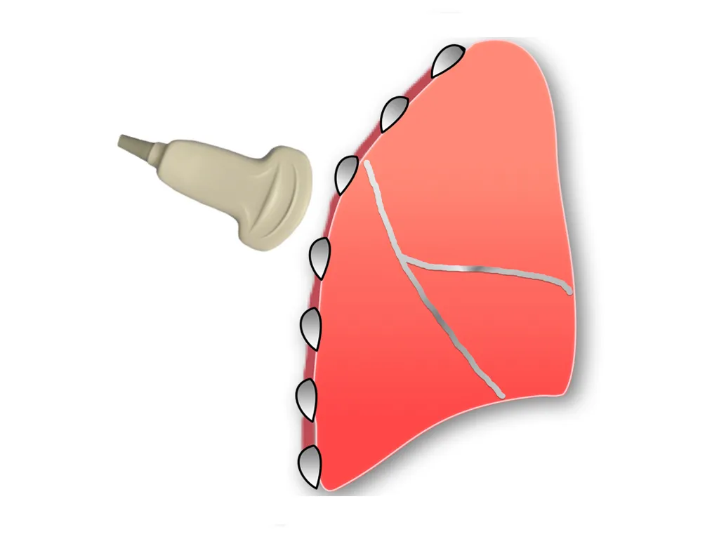 Pulmonary Ultrasound