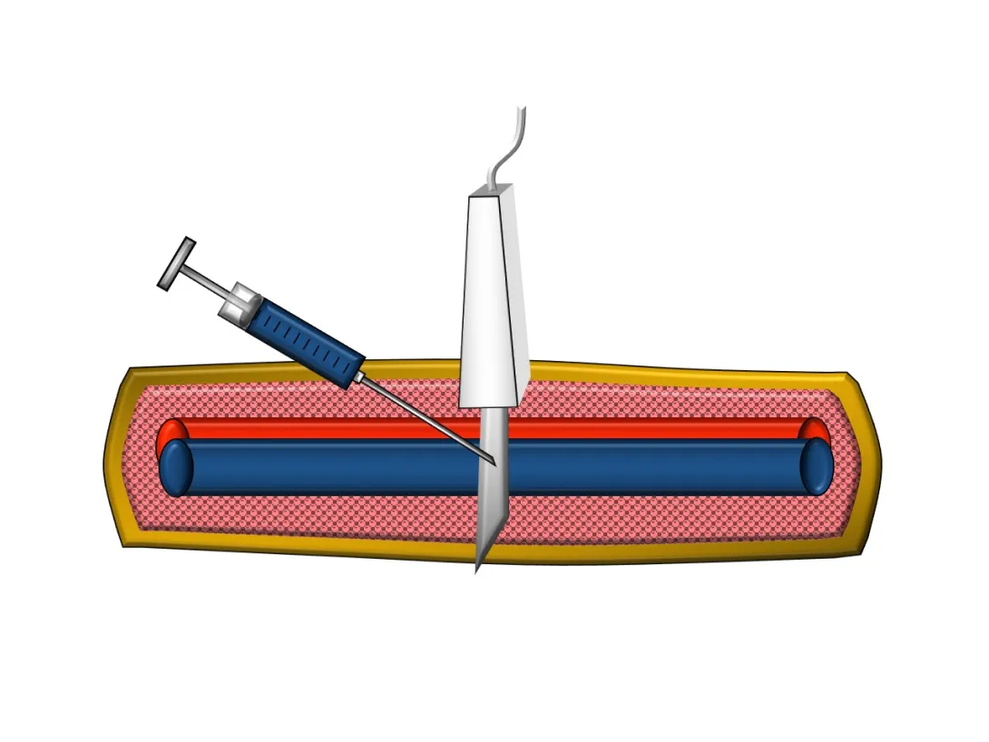 Vascular access