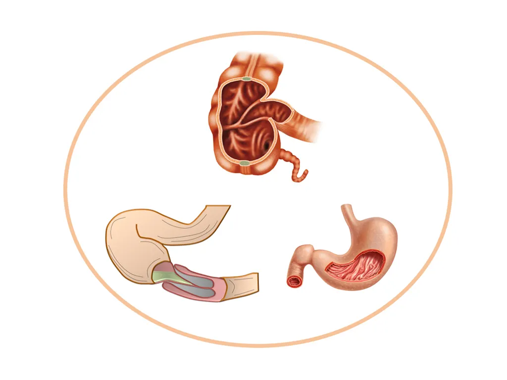Appendicitis, Intussusception & Pyloric Stenosis