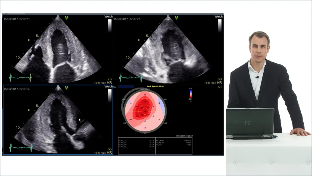 Left Ventricular Hypertrophy