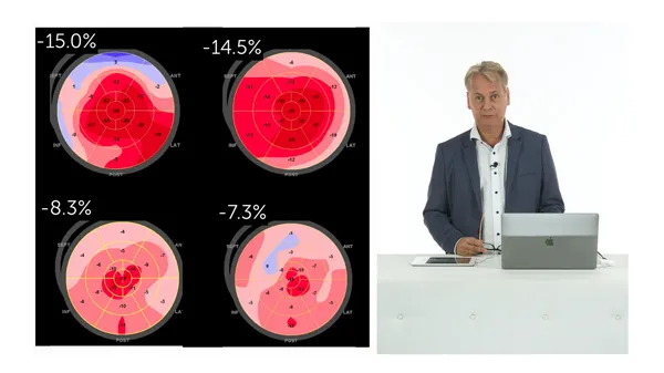 Dilated Cardiomyopathy