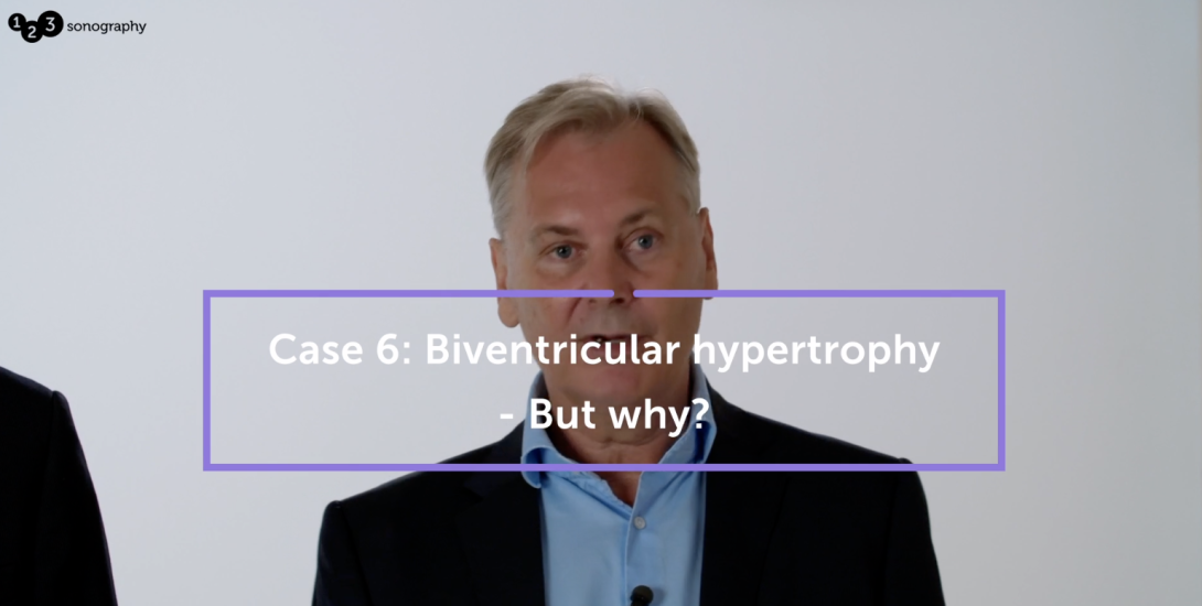 Biventricular hypertrophy – but why?