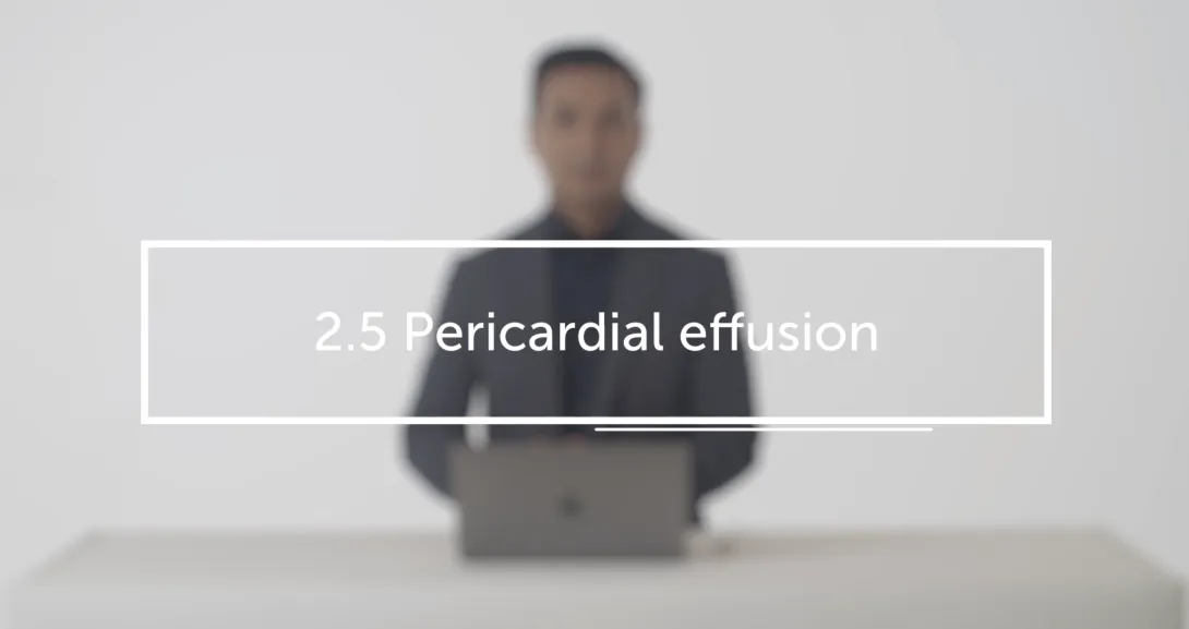 Pericardial effusion