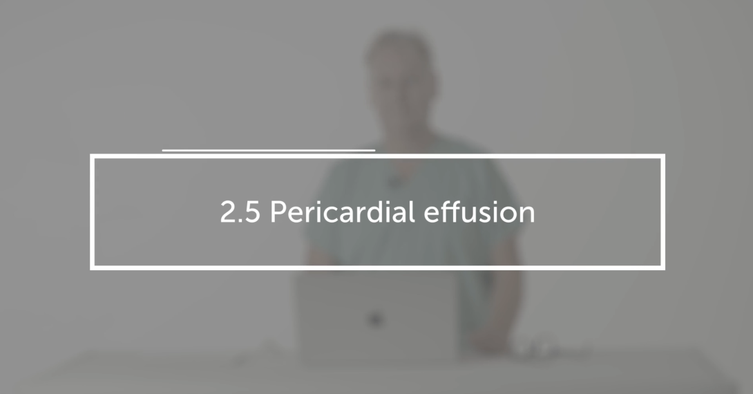 Pericardial effusion