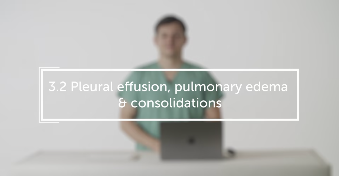 Pleural effusion, pulmonary edema & consolidations