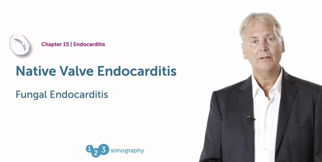 Native Valve Endocarditis - Fungal Endocarditis