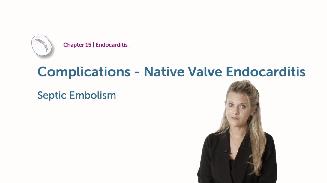 Complications of Native Valve Endocarditis - Septic Embolism