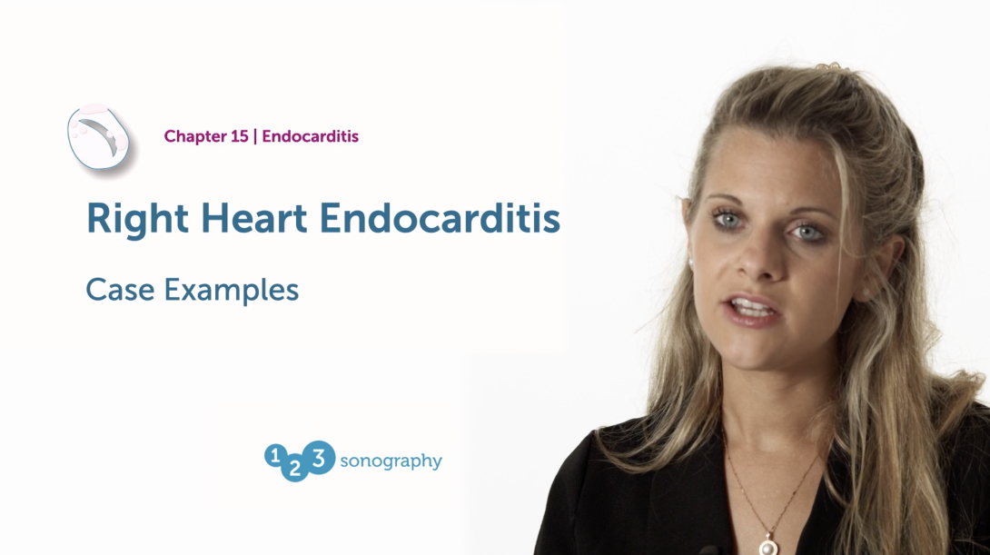 Right Heart Endocarditis - Examples