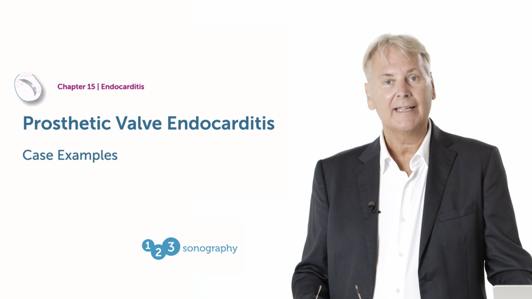 Prosthetic Valve Endocarditis - Examples
