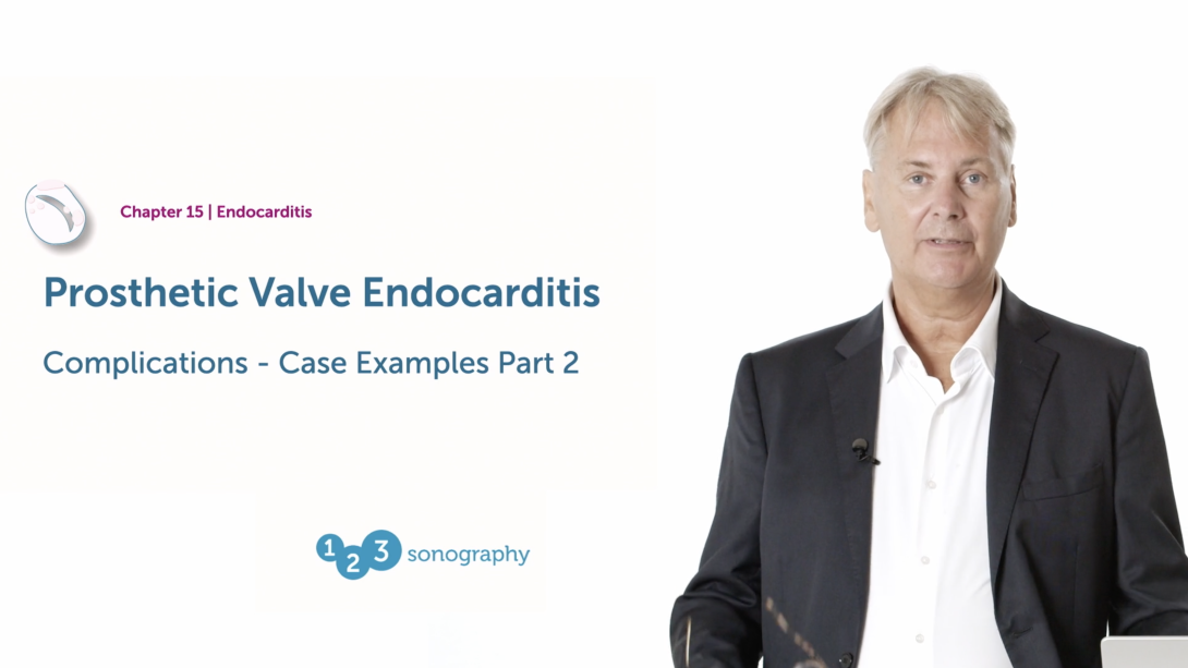 Prosthetic Valve Endocarditis - Complications - Part 2