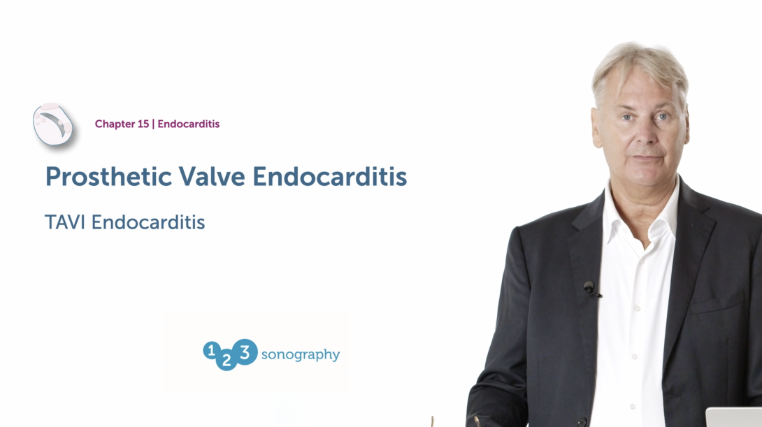 Prosthetic Valve Endocarditis - TAVI Endocarditis