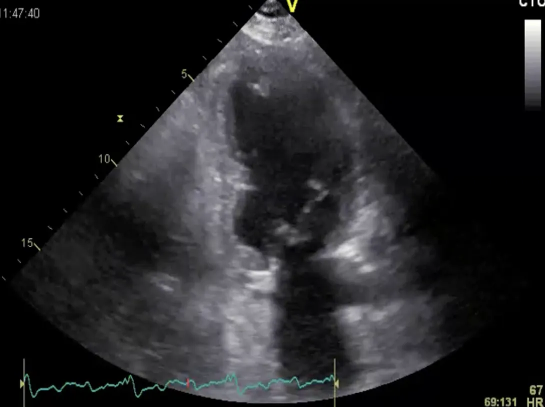 Ultrasound image.