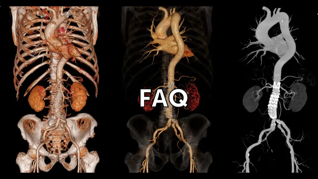 When is surgery of the aorta recommended?
