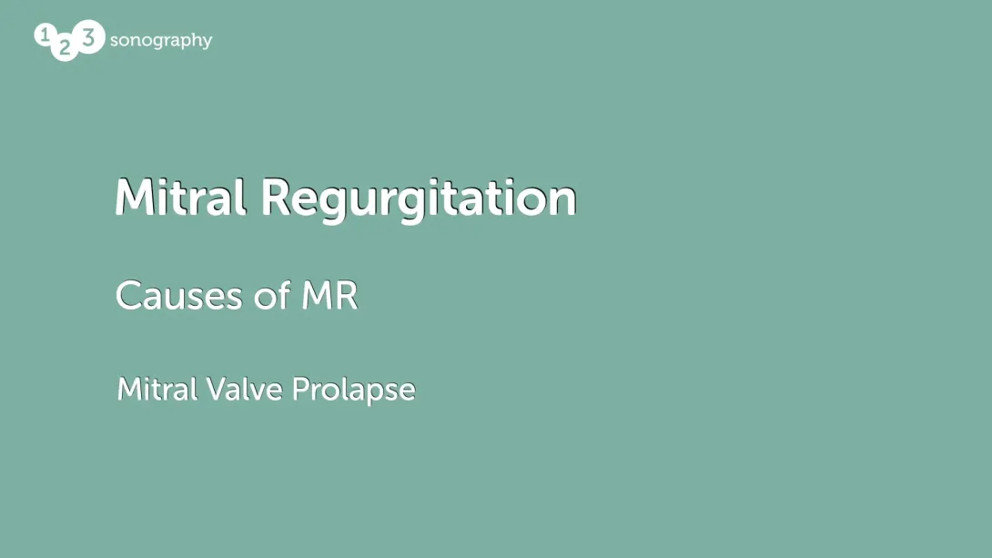 Mitral Valve Prolapse