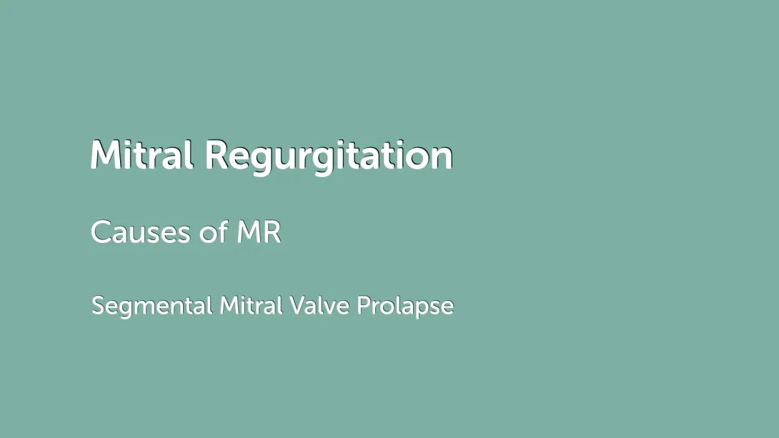 Segmental Mitral Valve Prolpase
