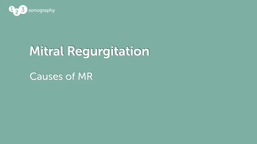 Mitral Annular Disjunction