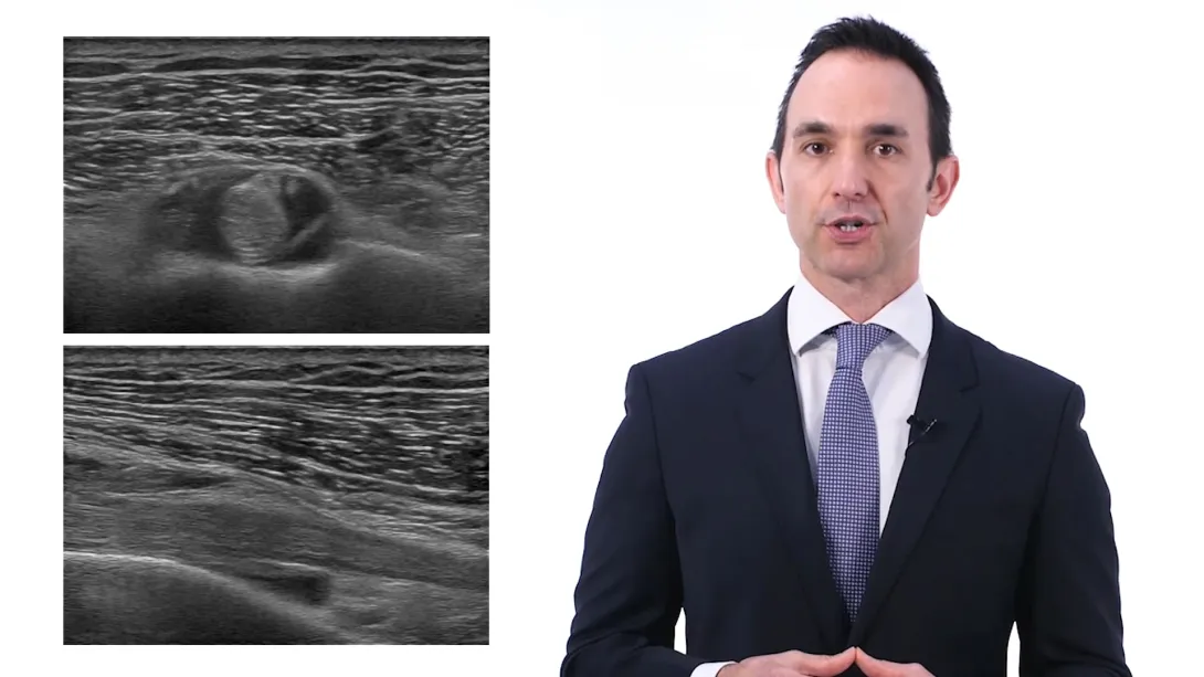 LHB tendon sheath Injection