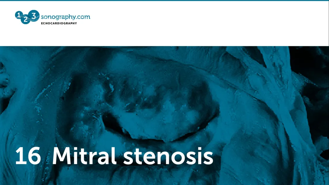 16 - Mitral stenosis