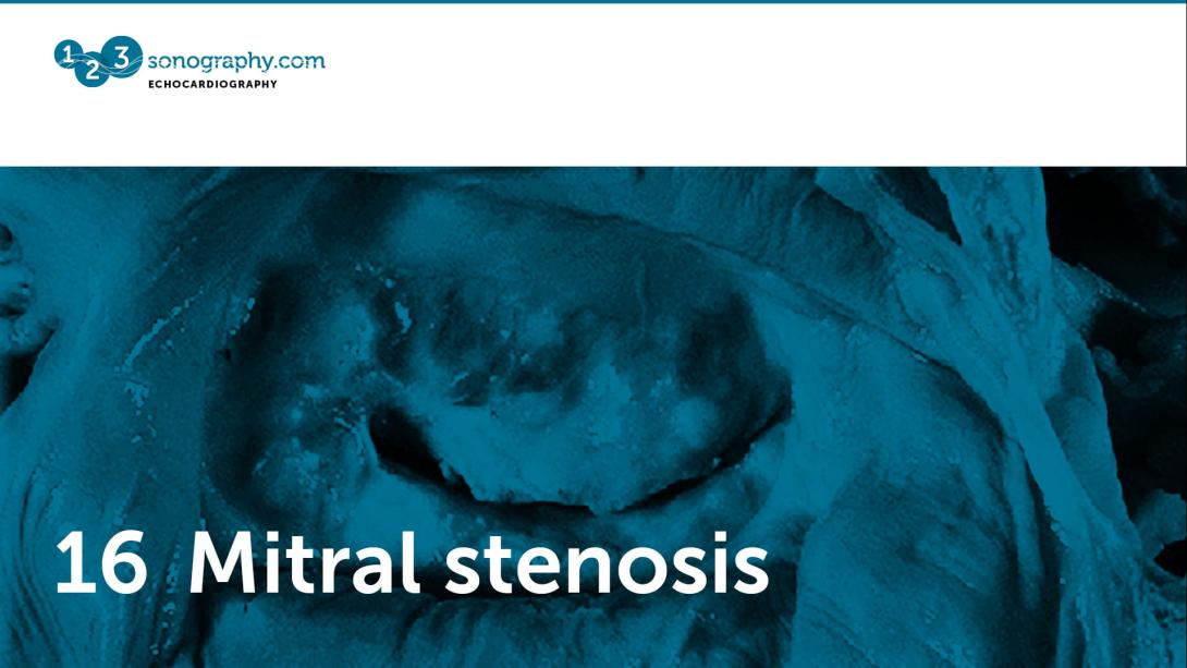 16 - Mitral stenosis