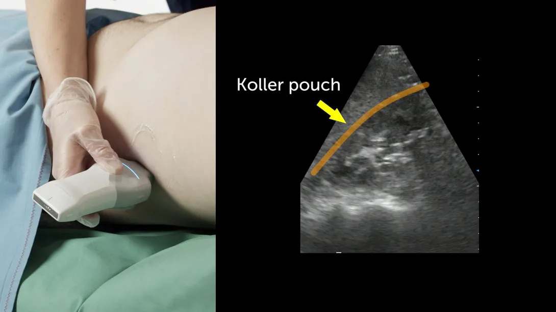 Kidney and urogential tract: Rock solid