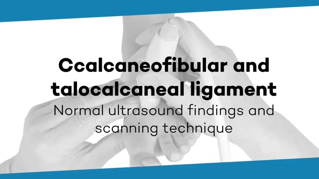Ligamentum calcaneofibulare