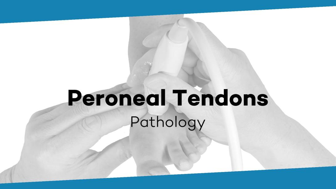 Peroneals - tenosynovitis - tendinosis - rupture