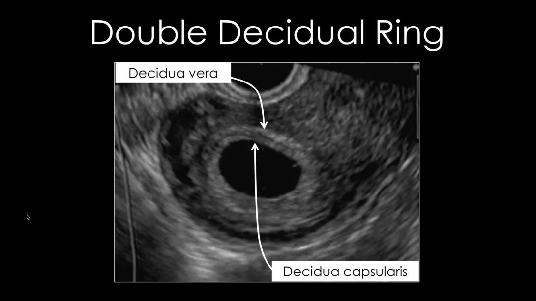 1st Trimester Pregnancy