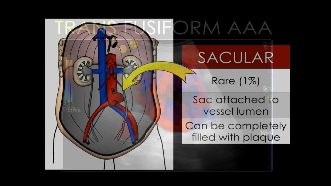 Abdominal Aortic Pathology